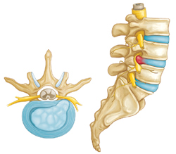 hernia